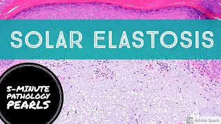 Solar Elastosis 5Minute Pathology Pearls [upl. by Dnaltroc]