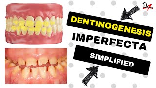 Dentinogenesis Imperfecta Simplified [upl. by Janot695]