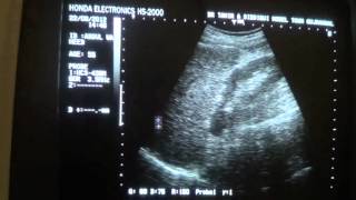 ultrasound of liver cirrhosis [upl. by Atteve]