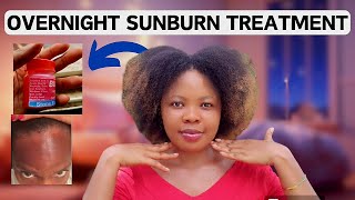 Best Sunburn Treatment👌 Clear sunburn fast Overnight Results 💯 How to clear sunburn [upl. by Htebazila]