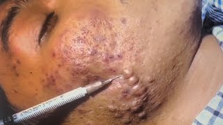 Big Cystic Acne Blackheads in Cambodia [upl. by Yetsirhc]