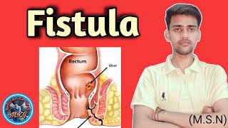 Fistula  fistula kya hai  fistula in MSN  fistula in nursing  Bsc nursing 2 year medicalkagyan [upl. by Nedroj]