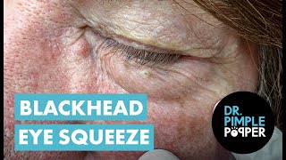 Blackhead Eye Squeeze [upl. by Catarina]