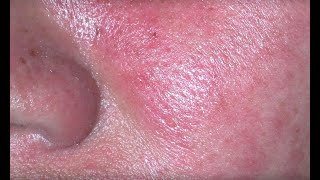 Rosacea  What is it [upl. by Parthenia]