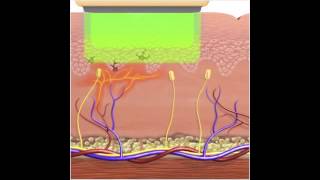 How IPL  Photorejuvenation works for Vascular Lesions [upl. by Eicarg]