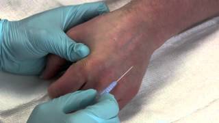 Intravenous Catheter Placement [upl. by Diane]