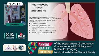 Pneumonia in immunocompromised pediatric patients [upl. by Leihcey]