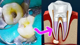 What is a Root Canal Treatment Procedure for Your Tooth Dentist Explains Endodontics [upl. by Artcele]