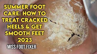 Summer Foot Care How to Treat Cracked Heels and Get Smooth Feet by foot Specialist Miss foot Fixer [upl. by Jennifer]