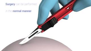 SwannMorton Disposable Retractable Scalpel [upl. by Aritak867]