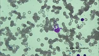 leishmania amastigotesSkin ulcer Giemsa Stain [upl. by Eimorej]