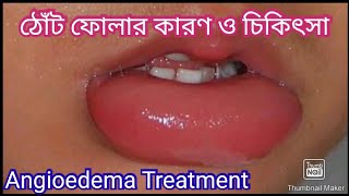 ঠোঁট ফোলার কারণ  ঠোঁট ফোলা কমানোর উপায়  Angioedema Treatment [upl. by Nellac]