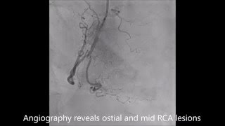 Stenting of an ostial and mid lesion of a right coronary artery [upl. by Leaw]