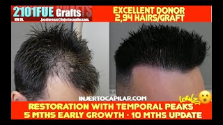 2101Grafts NW III Good donorAmazing 5mths growth10mths updateTemporal peaks 295hg 29292023 [upl. by Luigi]