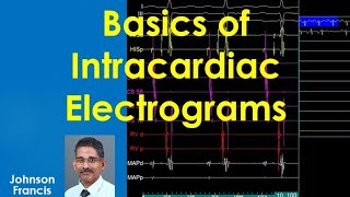 Basics of Intracardiac Electrograms [upl. by Aylat]