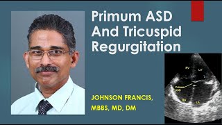 Primum ASD And Tricuspid Regurgitation [upl. by Noryb]