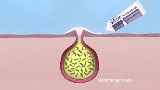 BENZAC TVCommercial [upl. by Blumenthal]