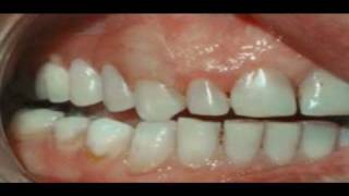 Why Have a Valplast Flexible Denture [upl. by Chace]