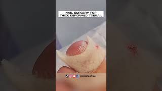 NAIL SURGERY FOR THICK DEFORMED TOENAIL 2023 BY MISS FOOT FIXER [upl. by Ailam]