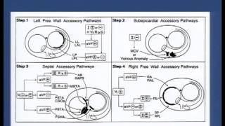 Pre  excitation syndromes  Dr Shashidhar 29092013 18 [upl. by Paley]