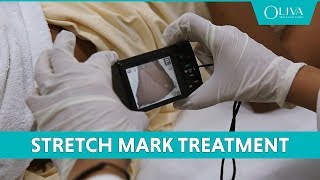 How To Remove Stretch Marks With Pixel Laser Resurfacing amp MNRF Treatments [upl. by Eilrak355]