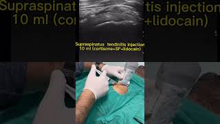 Subacromial impingement syndrome [upl. by Ennovad]