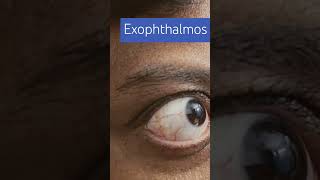 Exophthalmos imwell Exophthalmos [upl. by Leimad]