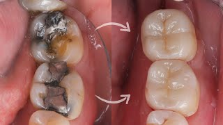 Ceramic ONLAY amp OVERLAY cementation StepbyStep [upl. by Grimbal661]