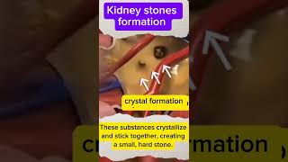 Kidney Stones LearnVisible Bodykidneystones kidneystoneformation [upl. by Udella]