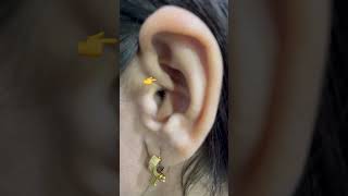 कान पस पड़ने से फूल गया क्या करें ear earproblems health viralshorts trendingshorts doctor [upl. by Molli495]