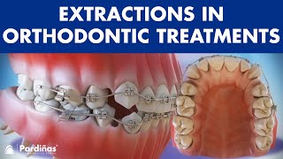 Extractions in Orthodontic Treatment  Is it necessary © [upl. by Lybis]