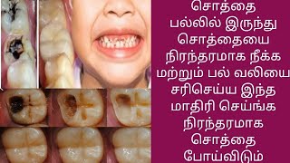 சொத்தை பல்லில் இருந்து நிரந்தரமாக சொத்தையை நீக்க இந்த மாதிரி செய்தால் போதும் [upl. by Einwahs552]