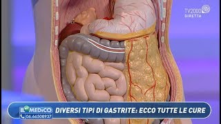 Il mio medico  Diversi tipi di gastrite ecco tutte le cure [upl. by Melburn]