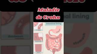 Maladie de Crohn inflammation chronique de lintestin SPA maladieschroniques crohn crohnsdisease [upl. by Salomon739]