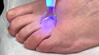 Neuroma Foot Pain Relief Treatment Using Alcohol Sclerosing Injections [upl. by Doxia]