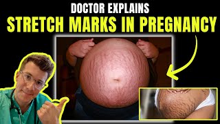 Doctor explains STRETCH MARKS in PREGNANCY  including signs clinical photos causes treatment [upl. by Aicnarf]