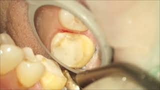 Maxillary first molar crown preparationlimited mouth opening [upl. by Shute]