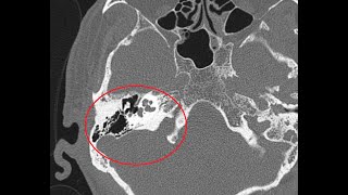 HRCT Temporal bone  A more detailed version  Basic to Advanced  AXIAL amp CORONAL VERSION 2 [upl. by Bosch]