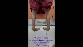 clubfoot treatment by Dr Sameer Desai [upl. by Etiuqram]