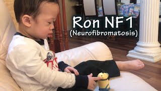 Your child got NF1 Neurofibromatosis [upl. by Winona]