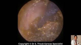 Top Biggest Ear Wax Removal 116  Ear wax Extraction  Dr S Thouk Earwax Specialist [upl. by Erena412]