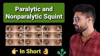 Paralytic vs Nonparalytic Squint lecture opthalmology [upl. by Lairbag]