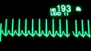 Supraventricular Tachycardia [upl. by Peednas101]