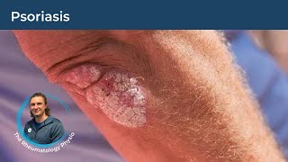 An Introduction To Psoriasis  INFLAMED SKIN  20 Minute Webinar [upl. by Tawney]