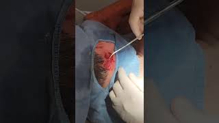 Epidermal Cyst Excision Neck [upl. by Aloiv332]