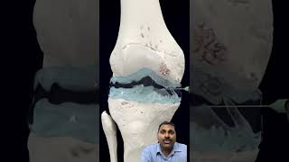 Knee injection for osteoarthritis [upl. by Eycal667]