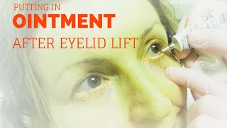 Putting ointment in your eyes after lower blepharoplasty [upl. by Alliehs]