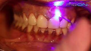 why more doctors prefer to use a dental laser in gingival depigmentation [upl. by Lovato138]