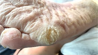 Callus removal from feetampFoot scraping dead skin【Xiao Yan pedicure】stress 915 [upl. by Katee138]