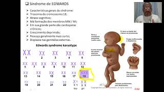 Aneuploidia Síndrome de EDWARDS [upl. by Koal152]